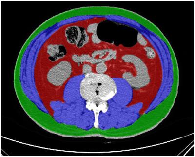 Sarcobesity, but not visceral fat, is an independent risk factor for complications after radical resection of colorectal cancer
